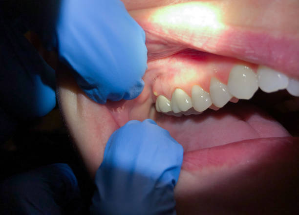 Best Dentist for Tooth Abscess  in Paoli, IN